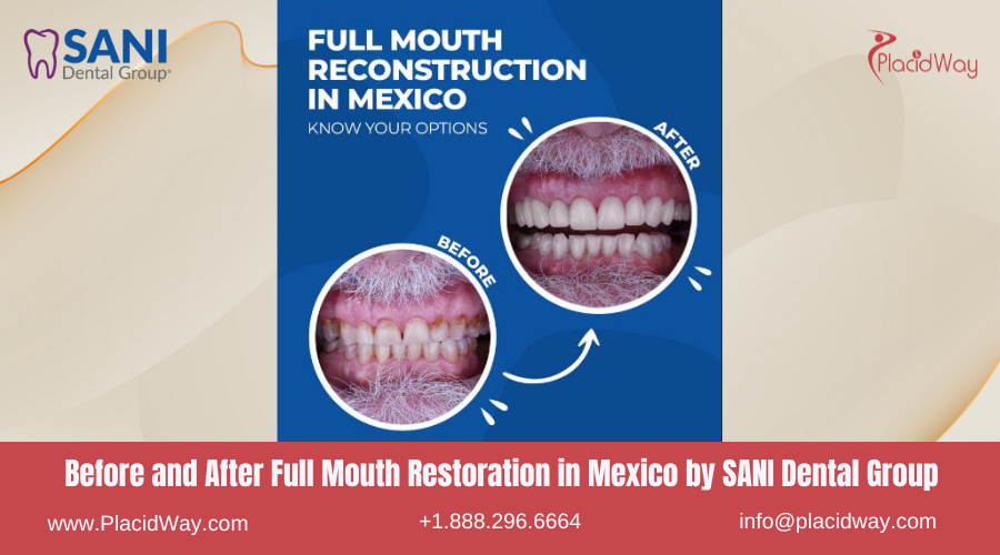 Full Mouth Restoration in Mexico Before and After Image by SANI Dental Group