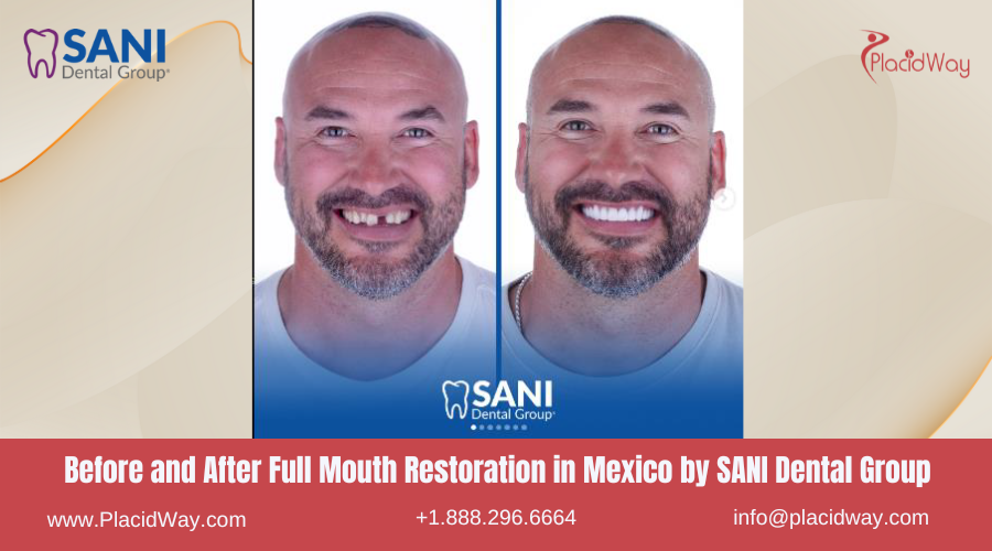Full Mouth Restoration in Mexico Before and After Image by SANI Dental