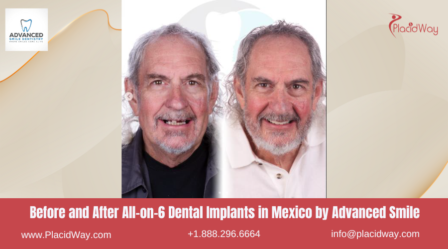 All on 6 Dental Implants in Mexico Before and After Image by Advanced Smile Dentistry