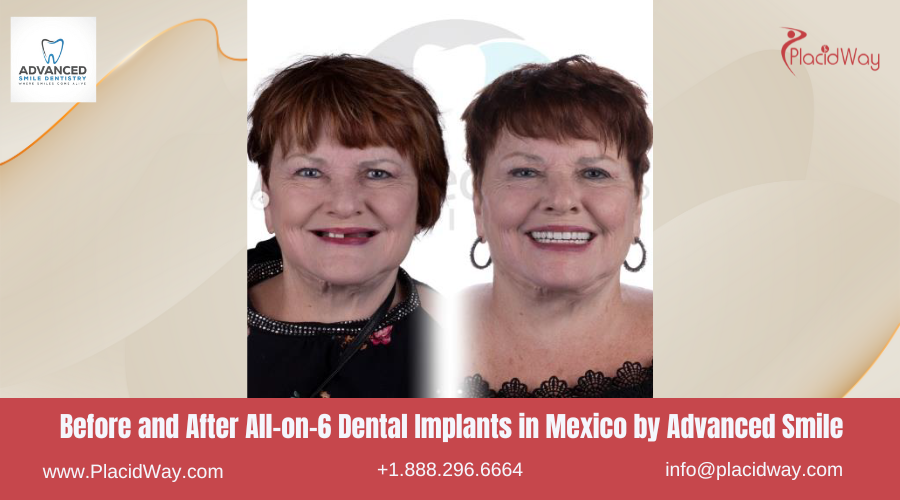 All on 6 Dental Implants in Mexico Before and After Image by Advanced Smile Clinic