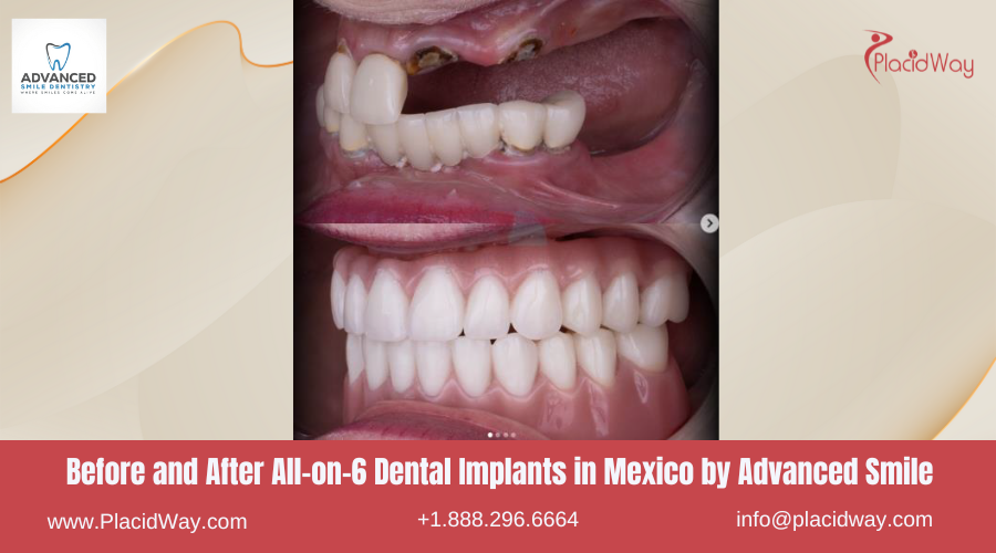 All on 6 Dental Implants in Mexico Before and After Image by Advanced Smile Dentistry