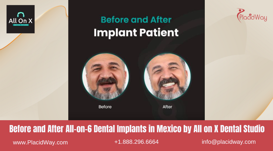 All on 6 Dental Implants in Mexico Before and After Image by All on X Dental Studio