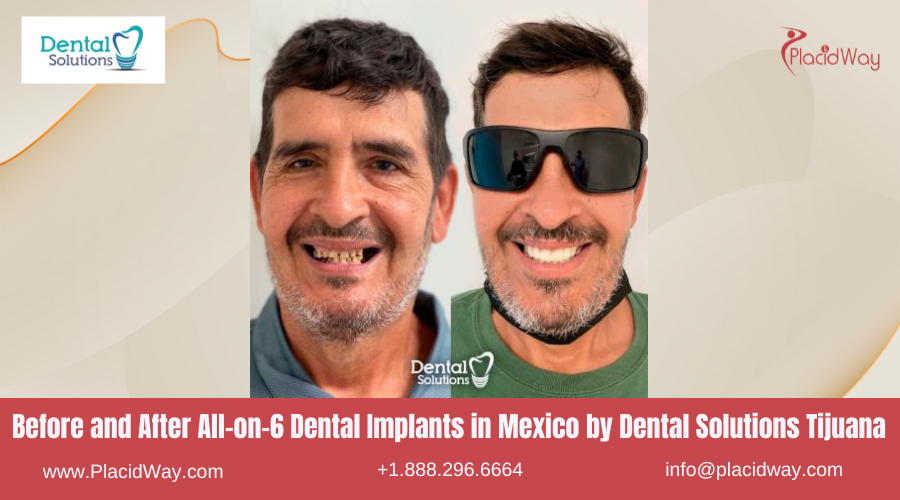 All on 6 Dental Implants in Mexico Before and After Image by Dental Solutions