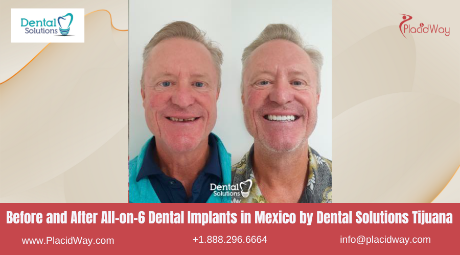 All on 6 Dental Implants in Mexico Before and After Image by Dental Solutions Clinic