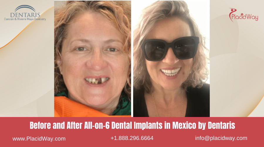 All on 6 Dental Implants in Mexico Before and After Image by Dentaris