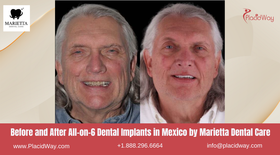 All on 6 Dental Implants in Mexico Before and After Image by Marietta Dental Care