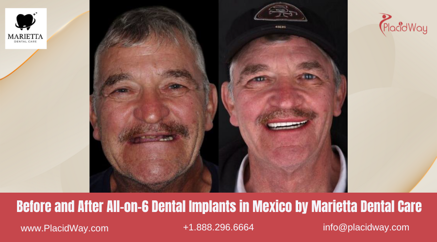 All on 6 Dental Implants in Mexico Before and After Image by Marietta Dental Clinic