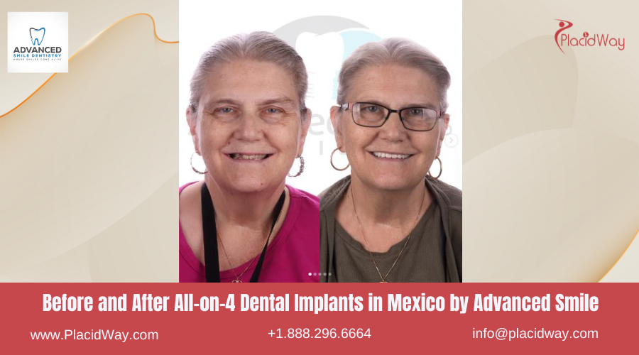 All on 4 Dental Implants in Mexico Before and After Image by Advanced Smile Dentistry