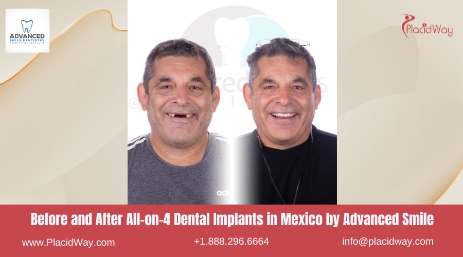 All on 4 Dental Implants in Mexico Before and After Image by Advanced Smile Clinic