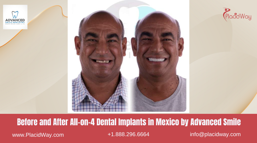 All on 4 Dental Implants in Mexico Before and After Image by Advanced Smile