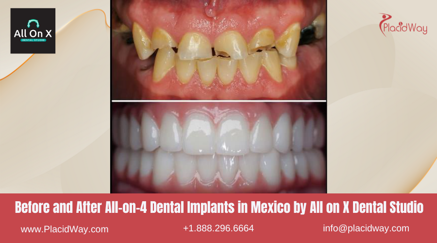 All on 4 Dental Implants in Mexico Before and After Image by All on X Dental Studio