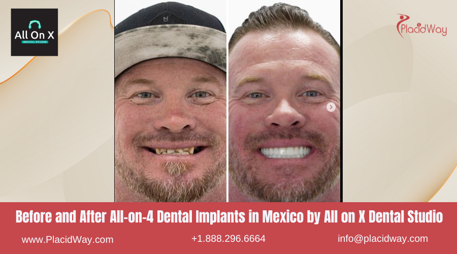 All on 4 Dental Implants in Mexico Before and After Image by All on X