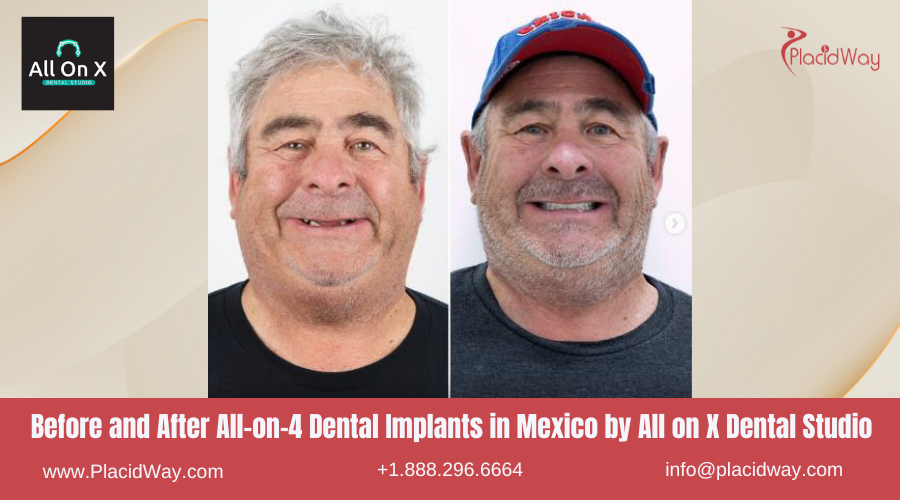 All on 4 Dental Implants in Mexico Before and After Image by All on X Dental Clinic