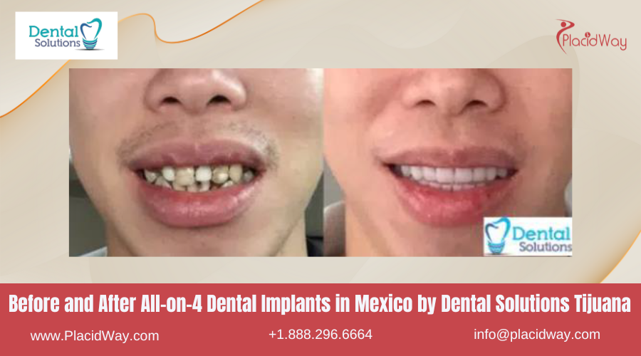 All on 4 Dental Implants in Mexico Before and After Image by Dental Solutions