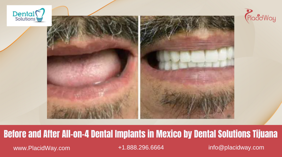 All on 4 Dental Implants in Mexico Before and After Image by Dental Solutions Clinic
