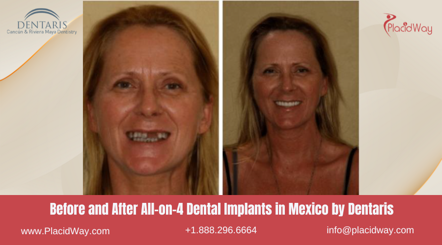 All on 4 Dental Implants in Mexico Before and After Image by Dentaris