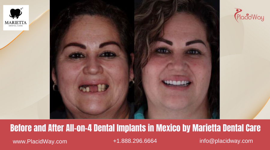 All on 4 Dental Implants in Mexico Before and After Image by Marietta Dental Care