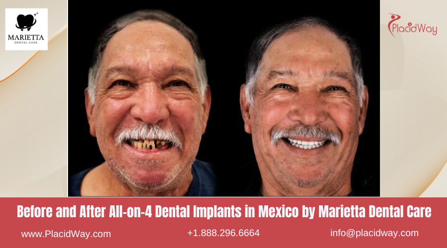 All on 4 Dental Implants in Mexico Before and After Image by Marietta Dental Clinic