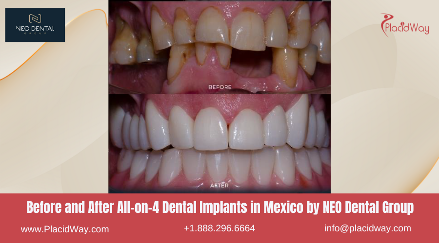 All on 4 Dental Implants in Mexico Before and After Image by NEO Dental Group