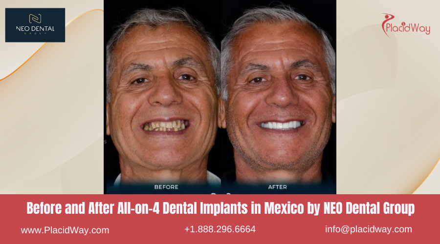 All on 4 Dental Implants in Mexico Before and After Image by NEO Dental
