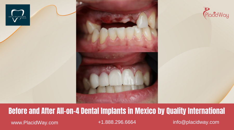 All on 4 Dental Implants in Mexico Before and After Image by QIDC