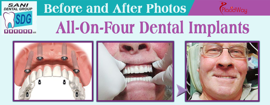 All on 4 Dental Implants in Mexico Before and After Image by SANI Dental