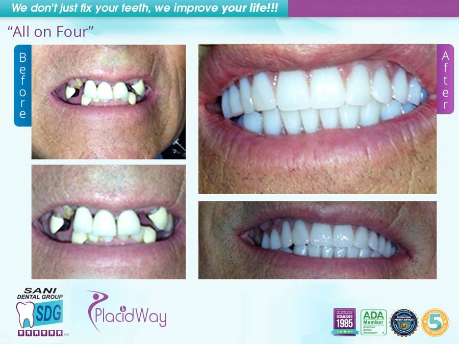 SANI All on 4 Dental Implants in Mexico Before and After Image