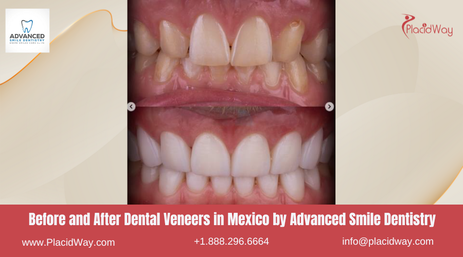 Dental Veneers in Mexico Before and After Image by Advanced Smile Dentistry