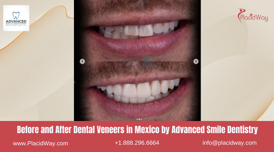 Dental Veneers in Mexico Before and After Image by Advanced Smile Dentistry Clinic