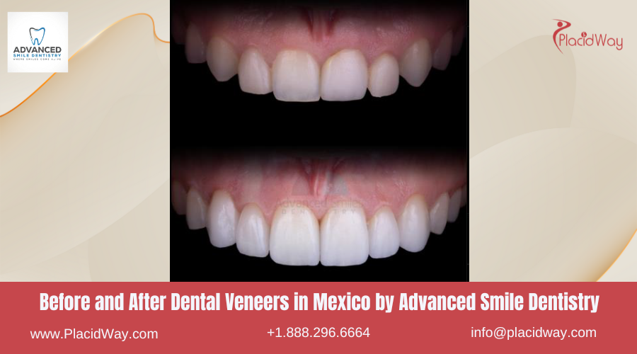 Dental Veneers in Mexico Before and After Image by Advanced Smile