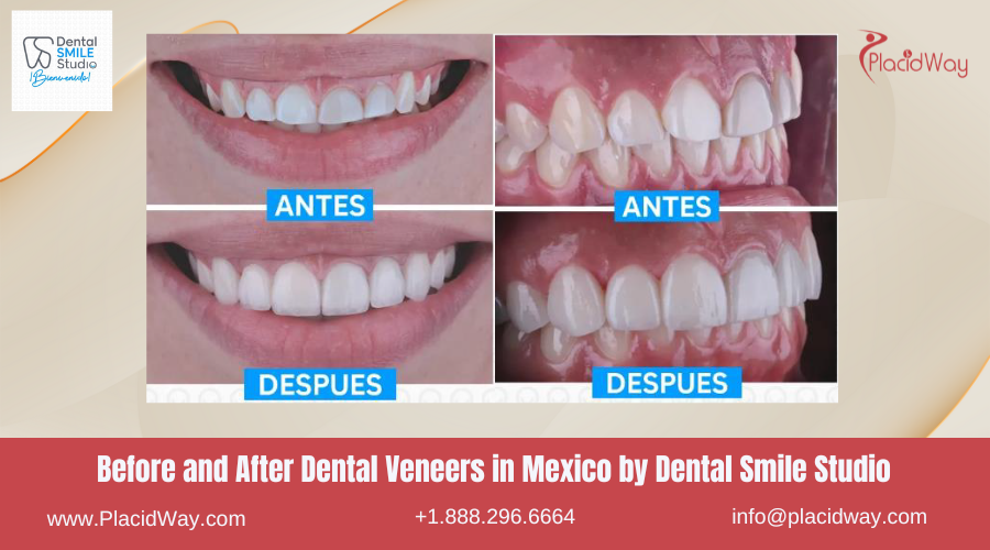 Dental Veneers in Mexico Before and After Image by Dental Smile Studio