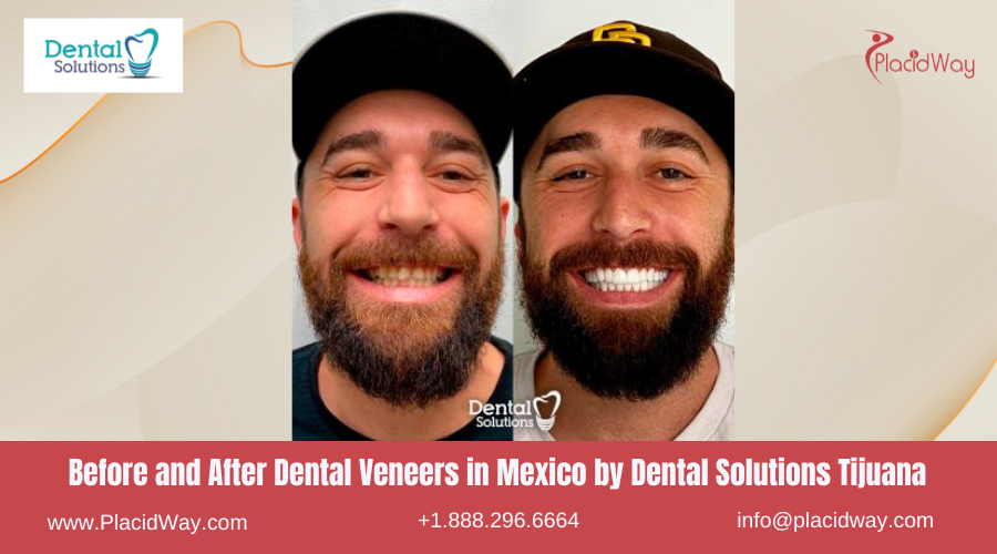 Dental Veneers in Mexico Before and After Image by Dental Solutions
