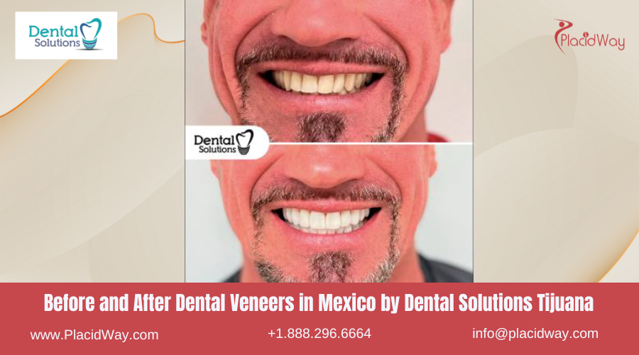 Dental Veneers in Mexico Before and After Image by Dental Solutions Center