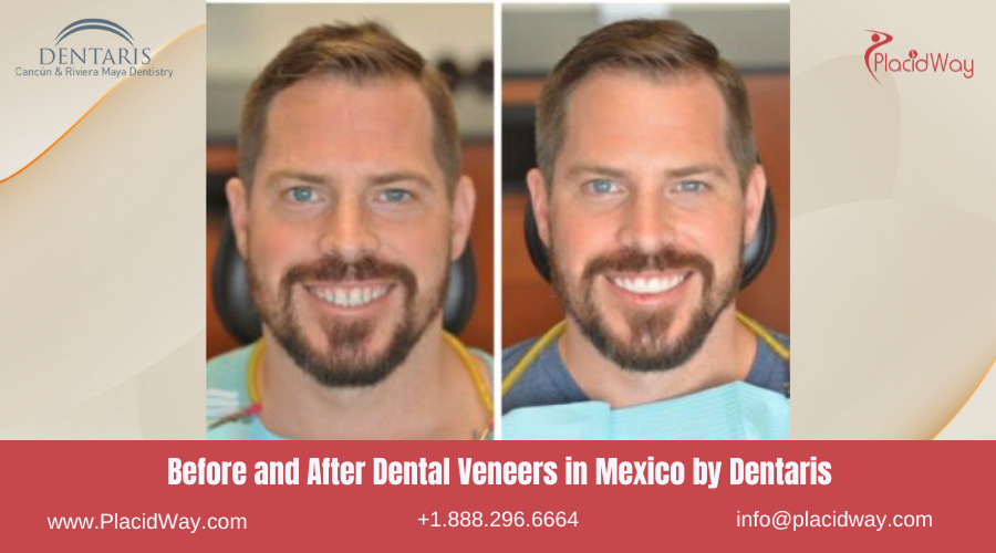 Dental Veneers in Mexico Before and After Image by Dentaris