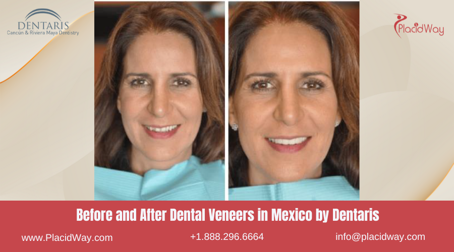 Dental Veneers in Mexico Before and After Image by Dentaris Clinic
