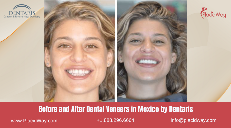 Dental Veneers in Mexico Before and After Image by Dentaris Cancun