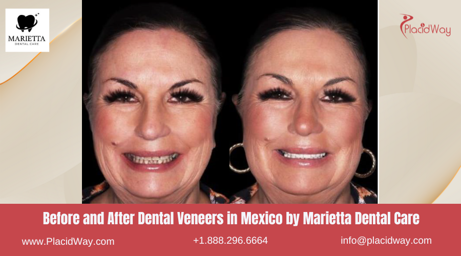 Dental Veneers in Mexico Before and After Image by Marietta Dental Care
