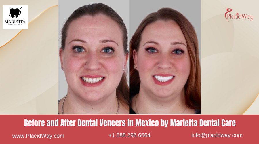 Dental Veneers in Mexico Before and After Image by Marietta Dental Clinic