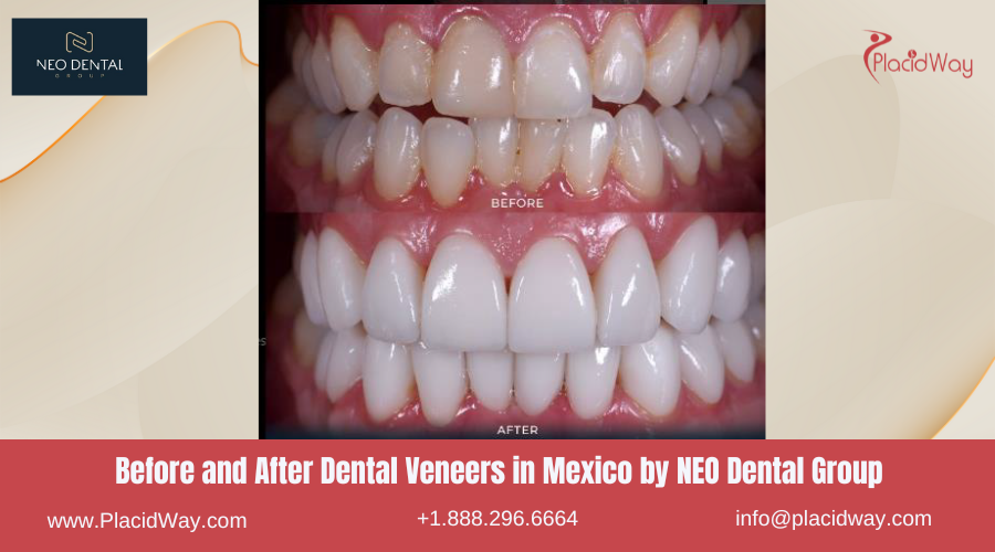 Dental Veneers in Mexico Before and After Image by NEO Dental Group