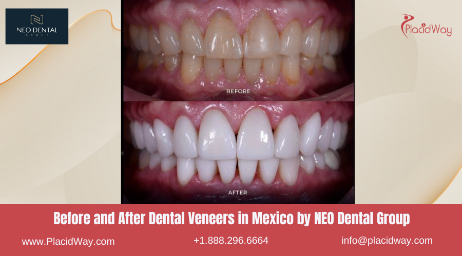Dental Veneers in Mexico Before and After Image by NEO Dental