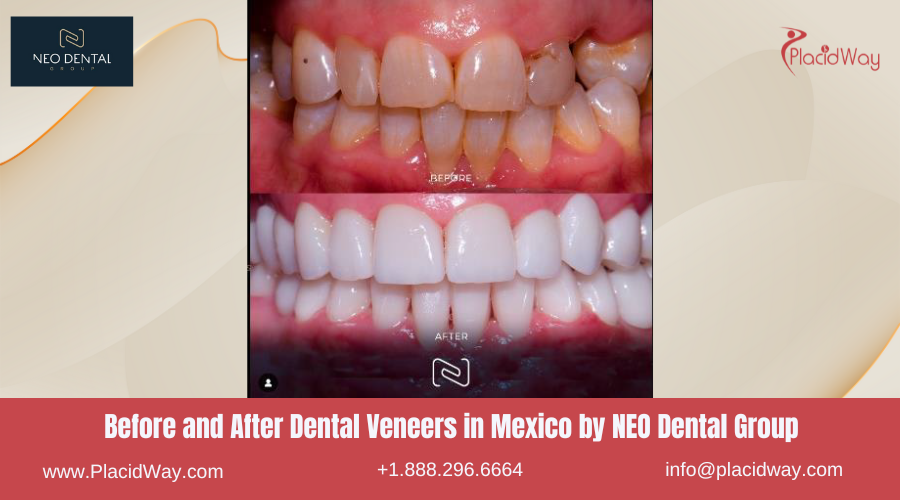NEO Dental Veneers in Mexico Before and After Image