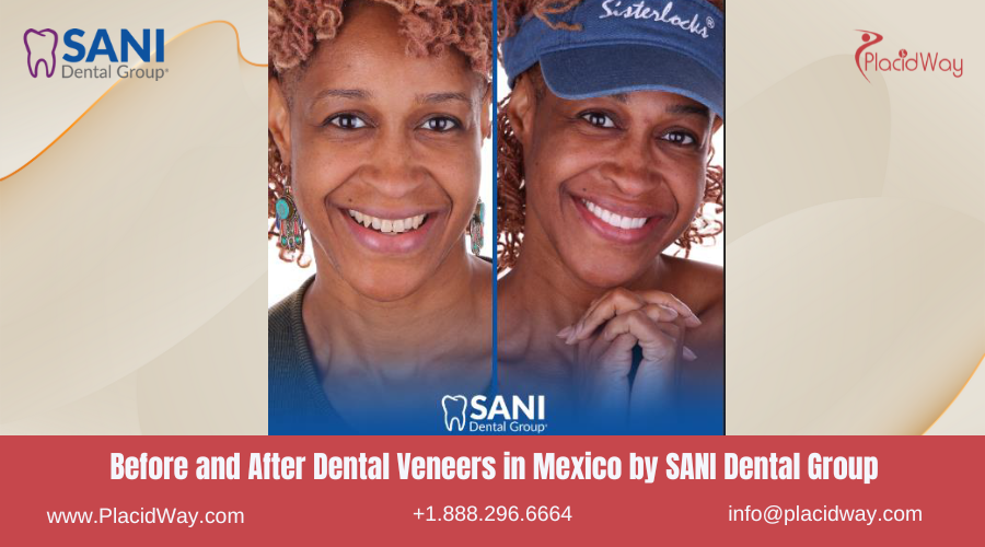 Dental Veneers in Mexico Before and After Image by SANI Dental Group
