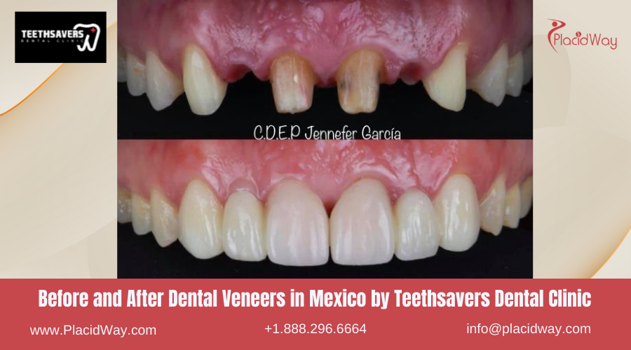 Dental Veneers in Mexico Before and After Image by Teethsavers