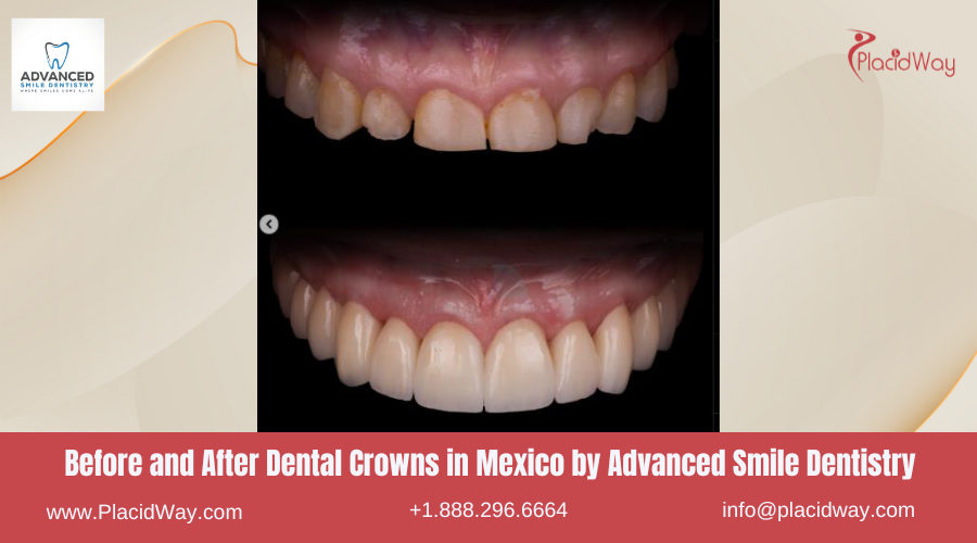 Dental Crowns in Mexico Before and After Image by Advanced Smile Dentistry