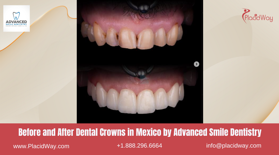 Dental Crowns in Mexico Before and After Image by Advanced Smile