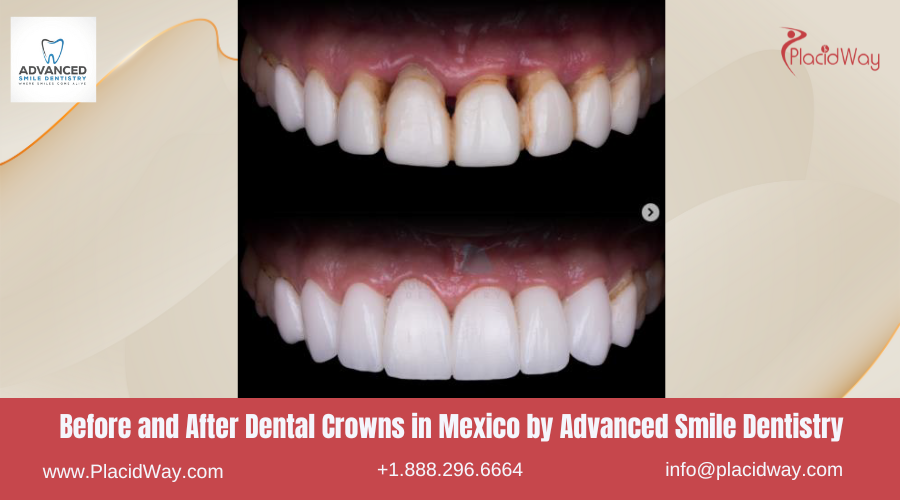 Dental Crowns in Mexico Before and After Image by ASD