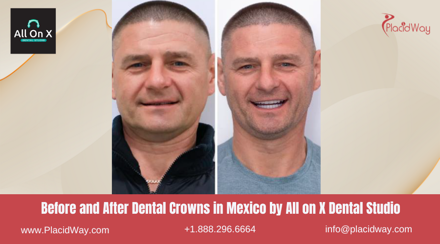Dental Crowns in Mexico Before and After Image by All on X Dental Studio