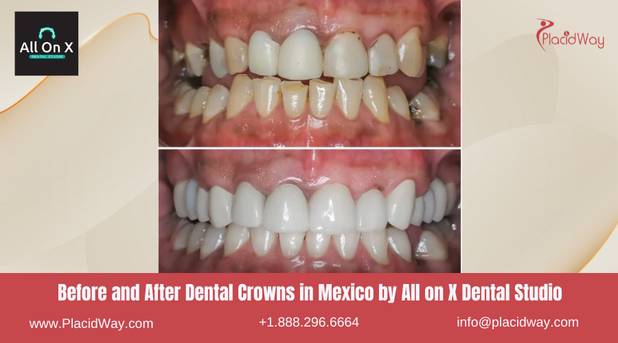 Dental Crowns in Mexico Before and After Image by All on X