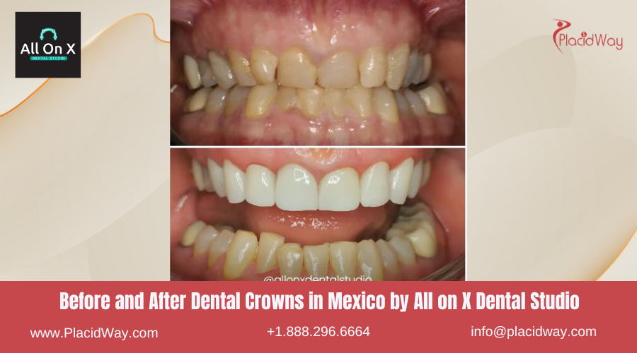 Dental Crowns in Mexico Before and After Image by All on X Dental Clinic