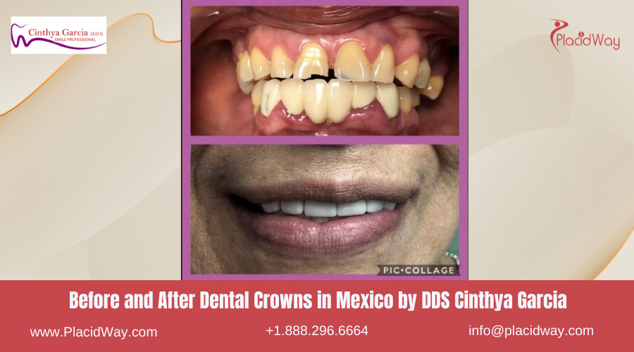 Dental Crowns in Mexico Before and After Image by DDS Cinthya Garcia